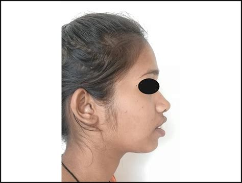 SOFT TISSUE PARADIGM|SDCINDIA