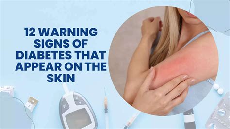 12 warning signs of diabetes that appear on the skin