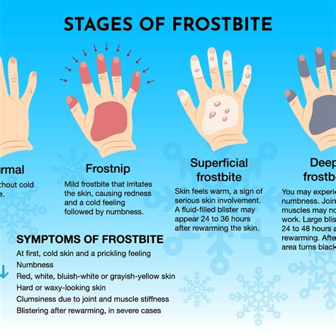 Frostbite