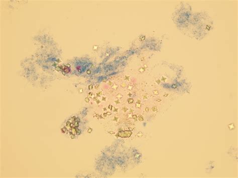 Amorphous Phosphate Crystals In Urine