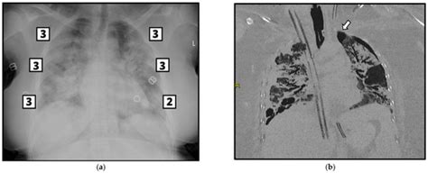 Chest X-ray at Emergency Admission and Potential Association with ...