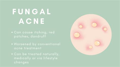 The 8 Types of Acne - And How To Treat Them | GoodGlow