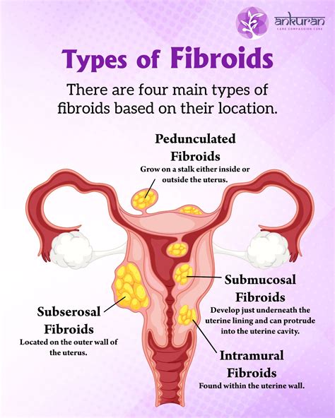 Which Size of Fibroid Is Normal and When to Consider Surgery?
