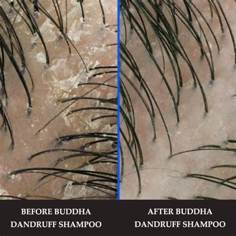 Buy Ayurvedic Dandruff Products Online At Buddha Natural
