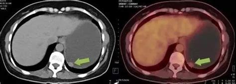 科学网—揭秘“隐形杀手”，中国科学家首次绘制人胃肠道间质瘤的蛋白质组图谱 - 卜晨的博文
