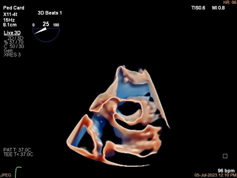 New Philips Mini TEE ultrasound transducer helps improve