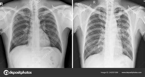 Image result for Normal X-ray
