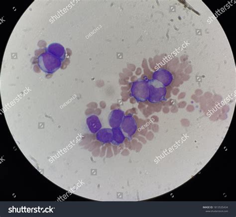 Blast Cells Peripheral Blood Smear Stock Photo (Edit Now) 1813535434