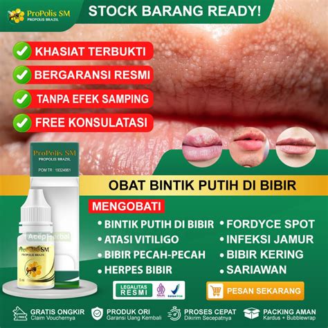 Jual Obat Bintik Putih Di Bibir Mengatasi Vitiligo Bibir Pecah-pecah Herpes Bibir Fordyce Spot ...