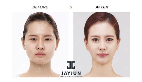 korean face contouring makeup korea facial contouring korea facial contouring surgery before and ...