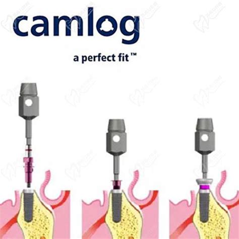 CAMLOG implantációs rendszer - BioLog