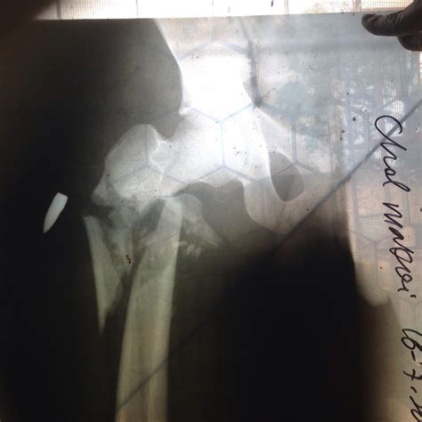 Gun Shot Wounds - Trauma - Orthobullets