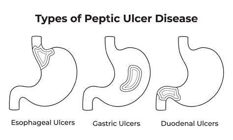Premium Vector | Types of Peptic Ulcer Disease Science Design Vector ...