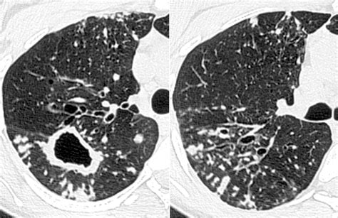 Tree-in-Bud Pattern at Thin-Section CT of the Lungs: Radiologic-Pathologic Overview | RadioGraphics