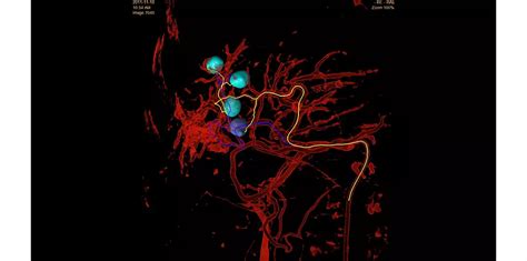 Philips - EmboGuide - Embolization guidance