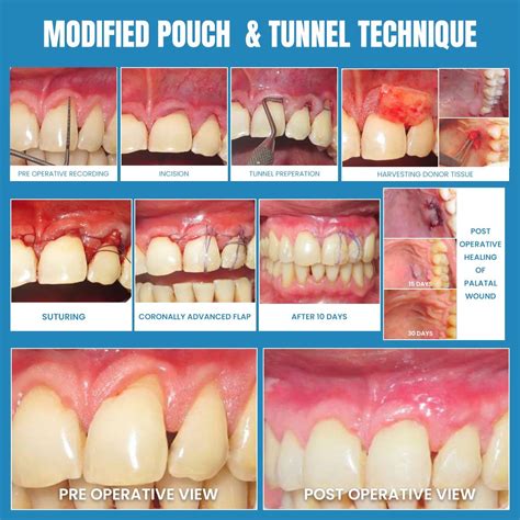 Step by Step process of POUCH AND TUNNEL TECHNIQUE The pouch-and-tunnel technique is a minimally ...