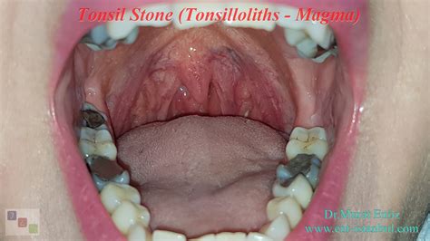 Tonsil Stone - Definition, Symptoms and Treatment