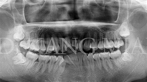 如何看牙科的X光片？牙片详解，教你看懂牙片！_口腔_牙齿_全景