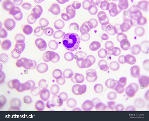 Band Form Neutrophil Cell (White Blood Cell) In Peripheral Blood Smear ...