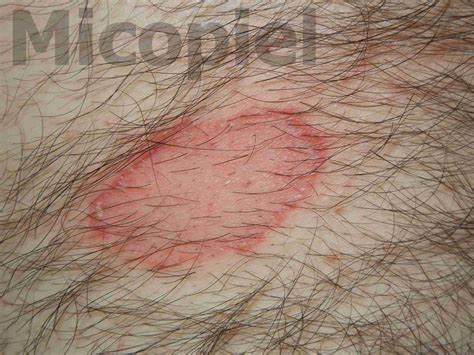 Caso clínico Nº 57. Tiña del Cuerpo – PIEL-L Latinoamericana