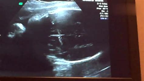 怀孕18周胎儿彩超图