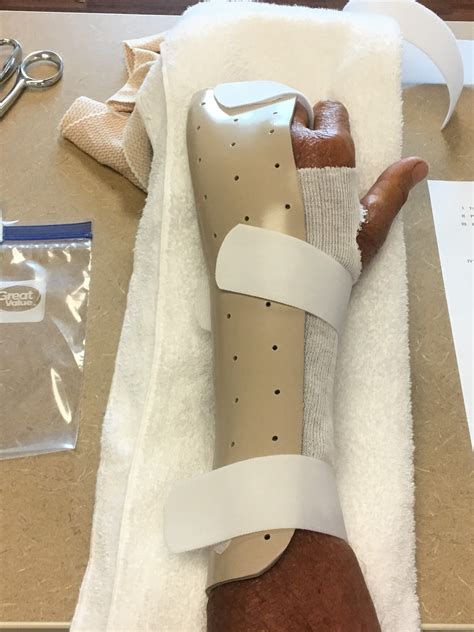 Image result for Finger Gutter Splint