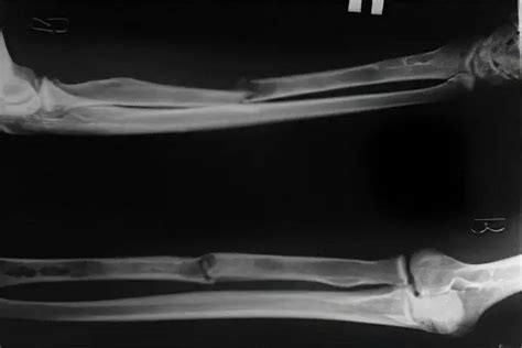 Image result for Simple Radius Fracture