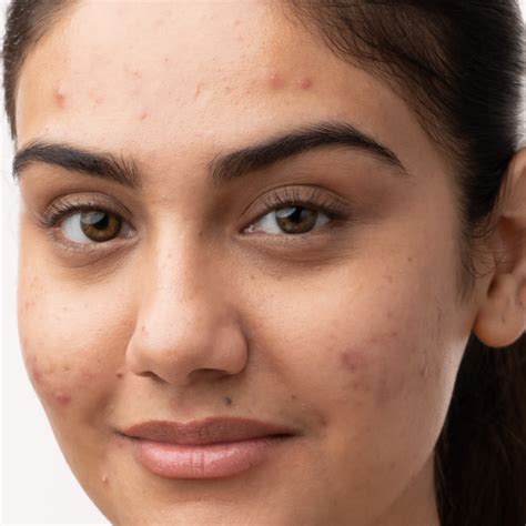 Buy Oil Control & Anti Acne Face Wash Online - Re'equil