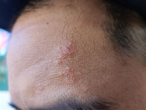 Shingles: The Itch Not to Scratch
