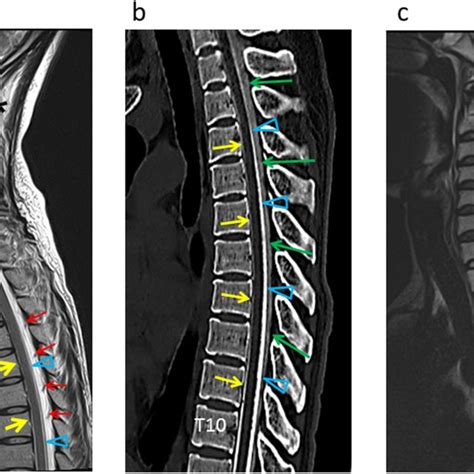 Illustration of disc-osteophyte complex size measurement. | Download ...