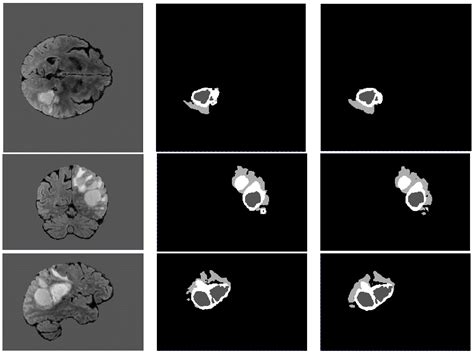 New Approach for Brain Tumor Segmentation Based on Gabor Convolution ...