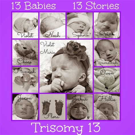 Trisomy 13 Baby