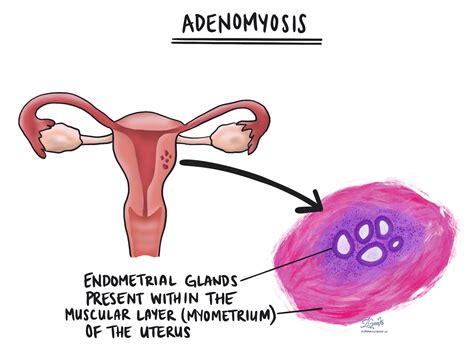 Adenomyosis: Definition – MyPathologyReport