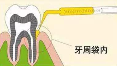 洗牙=齦上潔治≠深層清潔