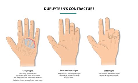 Dupuytren's Contracture - Florida Oncology Tavares