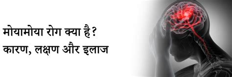 मोयामोया रोग क्या है? कारण, लक्षण और इलाज | What is Moyamoya Disease in ...