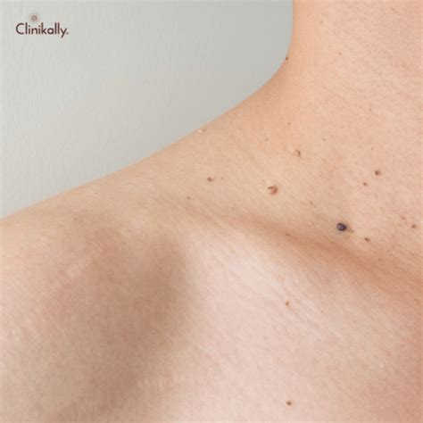 Wart Removal with Salicylic Acid: An Effective Treatment | Clinikally