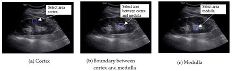 Classification of Chronic Kidney Disease in Sonography Using the GLCM ...