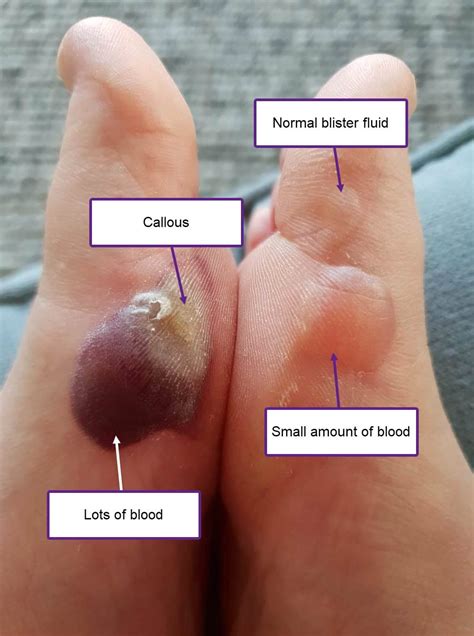Blister Fluid Colours: What's Inside Your Blister? - Blister Prevention