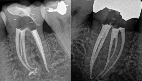 Scottsdale Root Canal Therapy - Loop 101 Endodontics