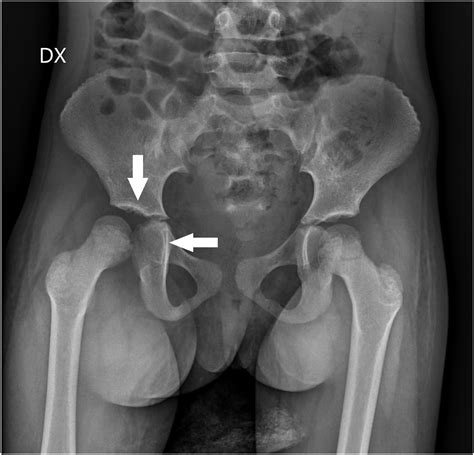 Child with high fever and knee pain - Annals of Emergency Medicine