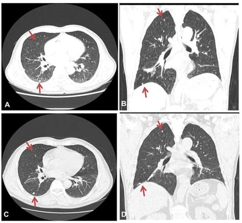 Asbestosis Mimicking Metastatic Lung Cancer: Case Report
