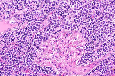 Non Hodgkins Lymphoma Cells