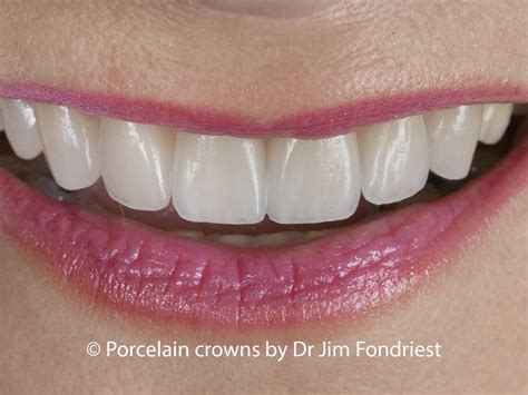 Types of Dental Porcelain Crowns