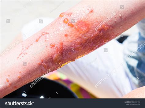 Severe Poison Ivy Rash Infection On Stock Photo 1561222174 | Shutterstock