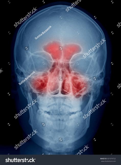 Sphenoid Sinus X Ray