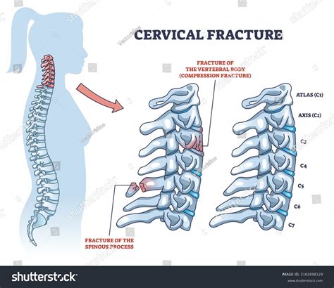 15 Fractured Spinous Process Cervical Vertebrae Images, Stock Photos ...