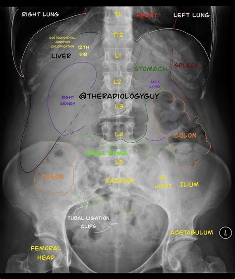 X ray abdominal anatomy – Artofit