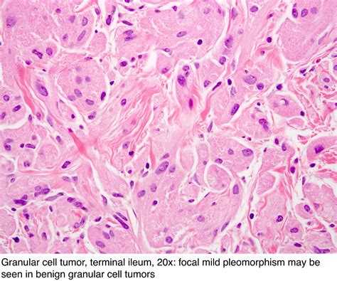 Pathology Outlines - Granular cell tumor