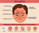 Sinusitis Treatment in Los Angeles & West Hills, CA | SoCal Sinus